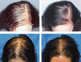 Laser Hair Therapy Nassau & Suffolk County NY | Hair Solutions of Long  Island