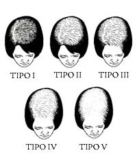 Female Pattern Baldness: Symptoms, Stages, Causes & Treatment