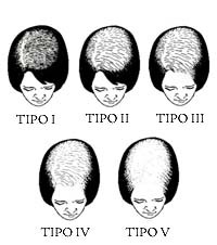 Ludwig scale  Types of hair loss – Neofollics