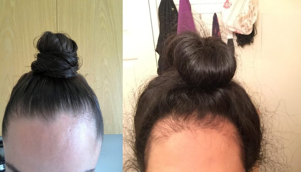 Ayanna Pressley Opens Up About Hair Loss From Alopecia Areata