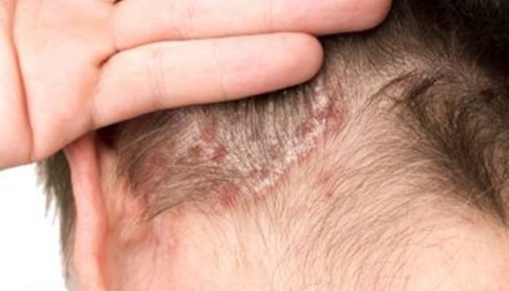 Burning scalp clearance hair loss