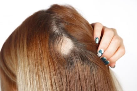 alopecia areata