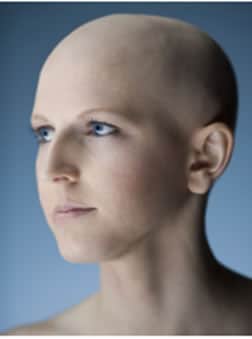 alopecia totalis