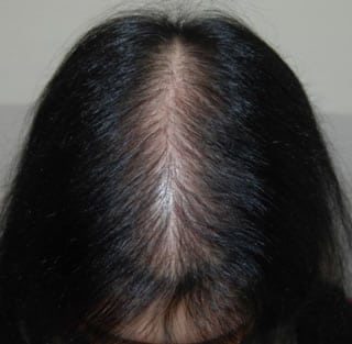 androgenic alopecia