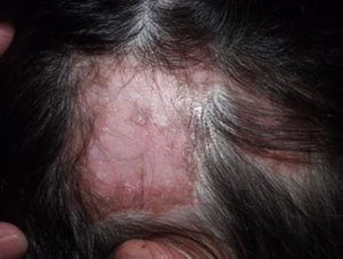 Cicatricial alopecia