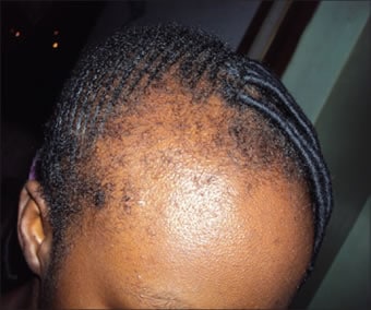 traction alopecia