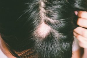 What is alopecia