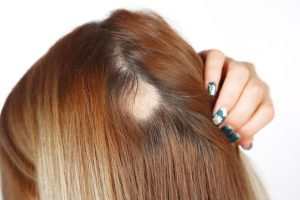 what causes alopecia to happen